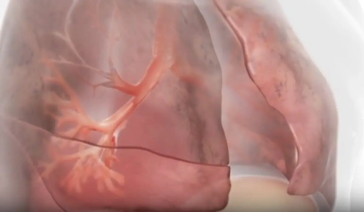 Innovazioni terapeutiche nella BPCO con enfisema